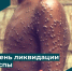 День ликвидации натуральной оспы - Центр гигиены и эпидемиологии
